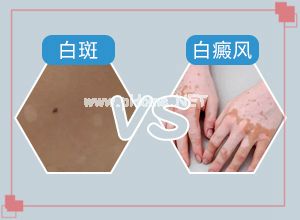 「订阅排行」出现白斑怎么办？怎样治疗白癜风