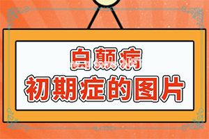 「白斑用什么方法治疗」应该怎么治疗和防护？诊疗注意什么