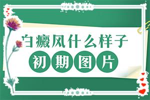 「治病防白」白斑初期的治疗方法「亲自」白臀风能治吗