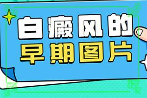 治疗白癜风的土方法(诊疗方法)白癜风能不能治疗好