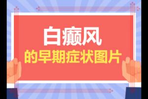 治疗能(治疗费用是多少)-白癞风怎么可以跟治吗